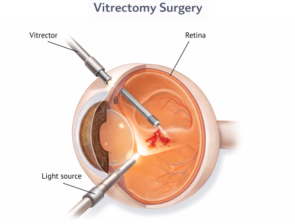 vitrectomy surgery